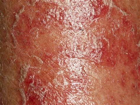 Skin Pathology Commonly Associated With Hiv Infection Infectious