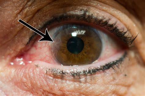 Pterygium Surgery And Pingueculum