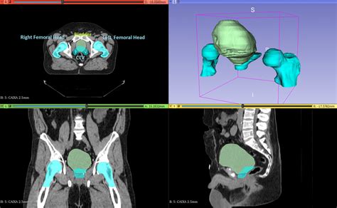 3d Slicer Interface Visualization Of Image Series Oars And Ctv