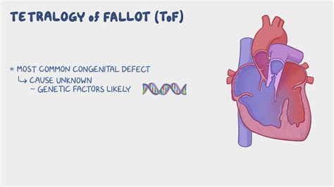 Tetralogy Of Fallot Video Anatomy Definition Osmosis 53 Off