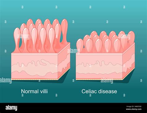 celiac sprue vector vectors  res stock photography  images alamy