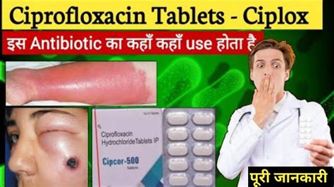 Ciprofloxacin Tablet Ciplox Tablet Zoxan Tablet Uses Side