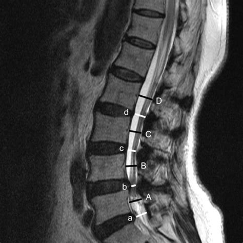 Measurement Of Ap Diameter Of Cervical Canal And Spinal Cord