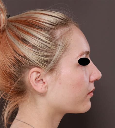 Rhinoplasty Archives Utah Facial Plastics