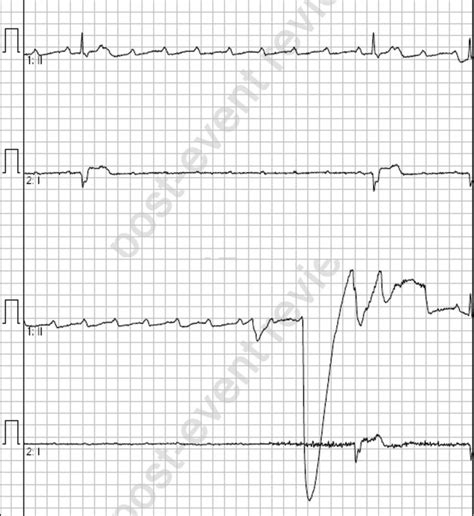 Paradoxical Worsening Of Bradycardia Following Atropine Administration