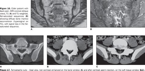 Figure From Sacroiliitis Imaging Evaluation Semantic Scholar