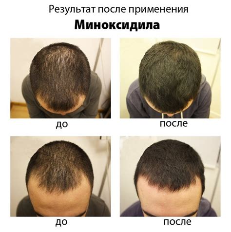 Миноксидил для роста волос: отзывы | Beauty Insider