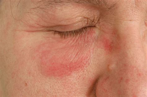 Periorbital Dermatitis Eyes