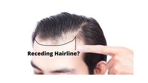 Receding Hairline [stages Signs And Treatment]