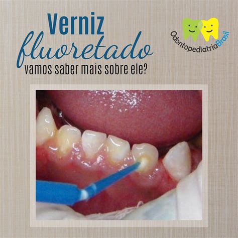 Fluor Para Os Dentes - Verniz Fluoretado – vamos saber mais sobre ele? – Odontopediatria Brasil