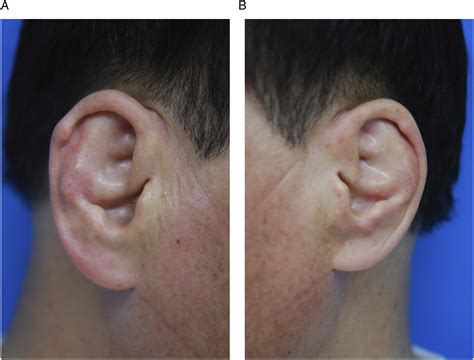 Bilateral Auriclar And External Ear Canal Cartilage Calcification