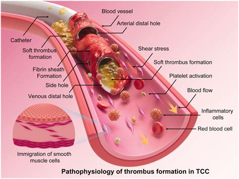 Pathology Of Thrombus Formation In A Tunneled Cuffed Catheter The