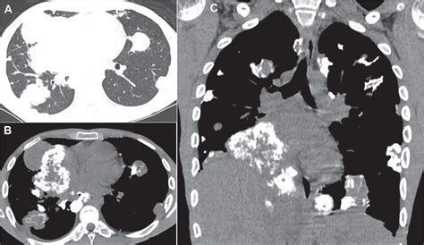 Scielo Brasil Computed Tomography Aspects Of Thoracic Metastases