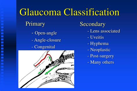 Ppt Glaucoma Powerpoint Presentation Free Download Id6422