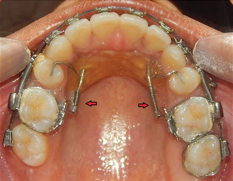 Distal Driving Of Molar By Smart Distal Propeller Appliance APOS