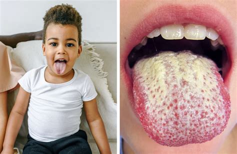 What White Tongue Is And What To Do About It Bright Side