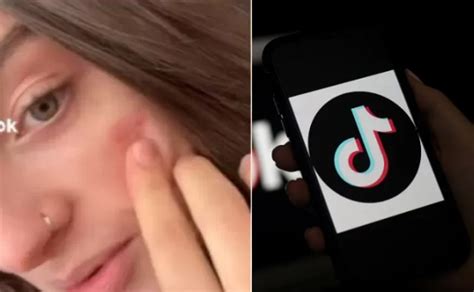 Advierten Sobre Peligroso Reto De Tiktok Conocido Como La Cicatriz