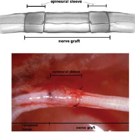 Results Of Pinprick Test At 3 6 And 12 Weeks After Grafting Groups