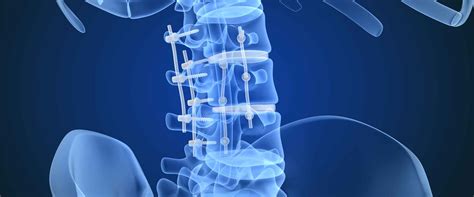 Why Are Peek Spinal Cages Ideal Medical Implants Genesis Medical Plastics