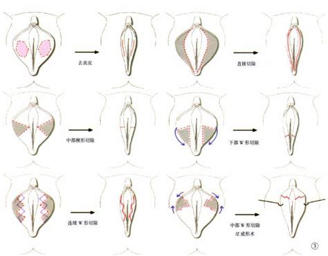 小阴唇肥大有必要手术吗？ 知乎