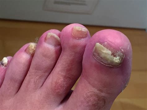 Fungal Nail Treatment - 'The Lacuna Method' - Foot Focus Foot Care ...