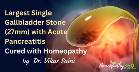 Largest Single Gallbladder Stone Mm With Acute Pancreatitis Cured