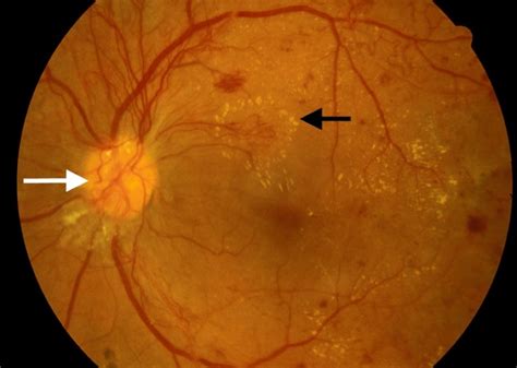 Diabetic Retinopathy Endotext Ncbi Bookshelf