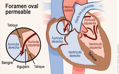 Foramen Oval Permeable