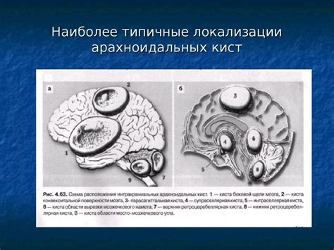 Мр картина ретроцеребеллярной арахноидальной кисты