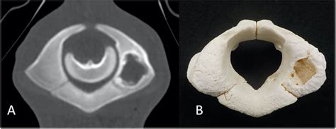 Autopsy Imagingcomputed Tomographic Image A And Gross Photograph B