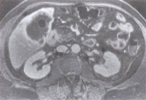 胆囊腺癌ct影像学 医学影像图医学图库
