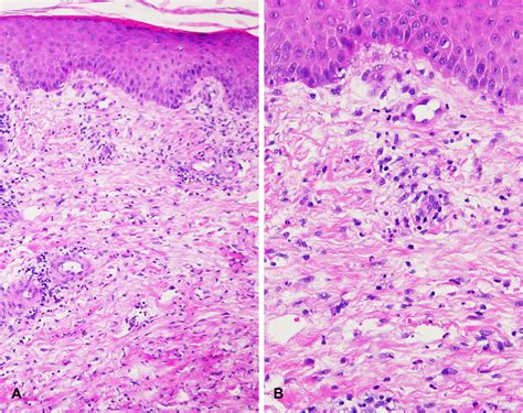 Localized aseptic neutrophilic dermatoses of the extremities triggered