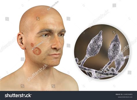 Microsporum Canis Fungal Infection On Mans Stock Illustration ...