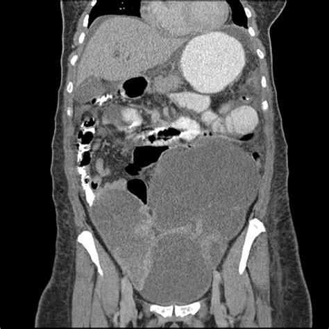 Gastric Ulcer And Abnormal Findings On CT AAFP