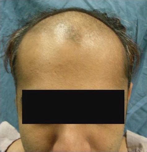 Androgenetic Alopecia An Update Indian Journal Of Dermatology