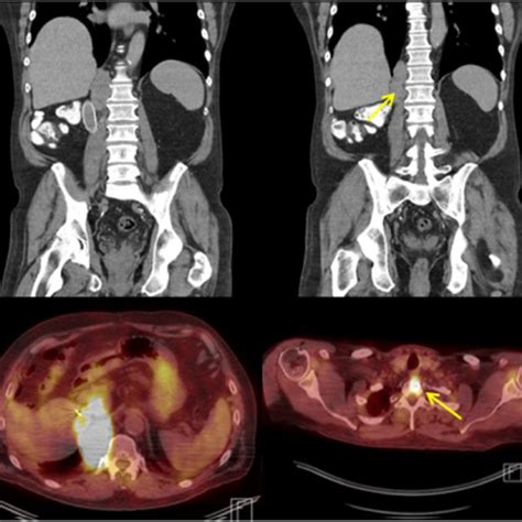 (A) Surveillance CT scan demonstrating retrocrural recurrence ...