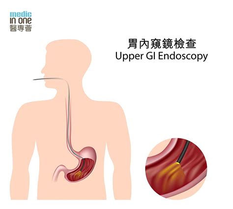 胃內窺鏡檢查｜檢查流程及準備｜醫專薈腸胃鏡檢查資訊中心