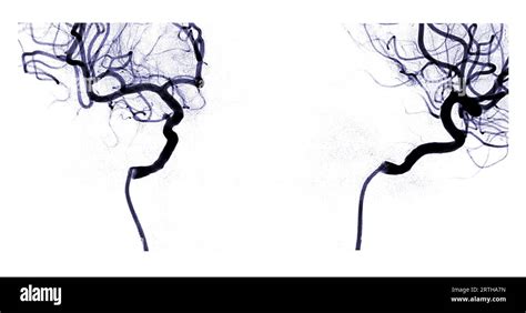 Cerebral Angiography Image From Fluoroscopy In Intervention Radiology Showing Cerebral Artery