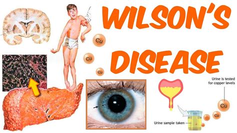 Wilsons Disease Youtube