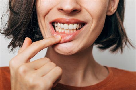 Consejos Para Evitar Una Gingivitis Smile More Clinic