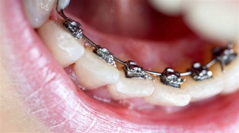 Braces For Adults In Brownsville Rio Grande City And Edinburg Texas