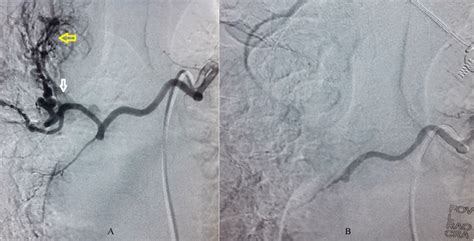 A Digital Subtraction Angiography Showed Abnormal Blush In Right Download Scientific Diagram