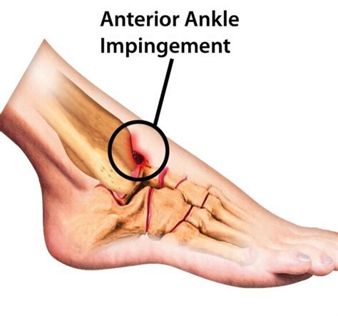 Ankle pain-when a sprain is NOT so simple - Sans Souci Physio