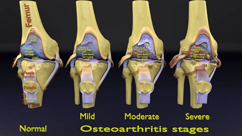 knee osteoarthritis stages 3d blend - Blender Market