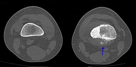 CBR Bradcases Osteossarcoma Principais Achados De Imagem