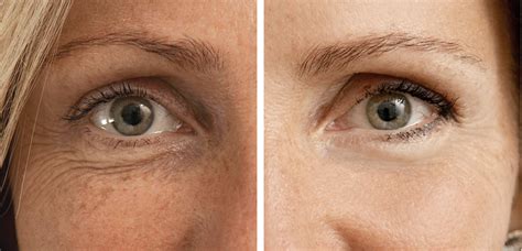 Fusion Mesotherapy - Beauty Works