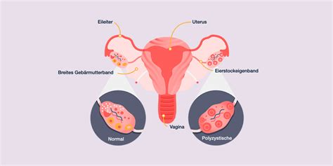 Hashimoto Und Polyzystisches Ovarialsyndrom Pcos By Boost Thyroid