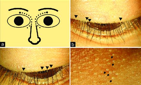 Presumed Migration Route Of Demodex Mites From Facial Demodicosis To