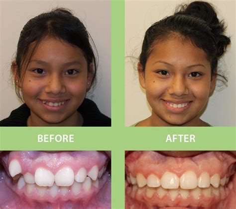 Smile Gallery Prettyman Orthodontics