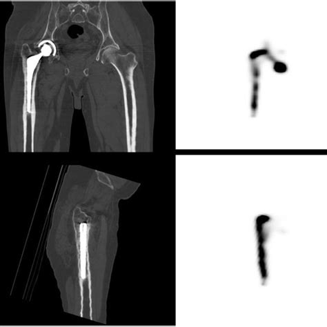 Tibial Component Loosening Of A Left Knee Total Arthroplasty The Download Scientific Diagram